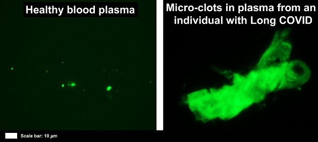 Blood clots Long COVID.jpg